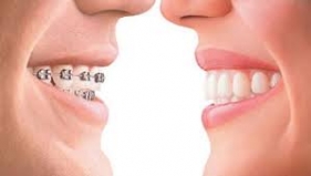 Aparaty ortodontyczne czy dyskretne nakładki ortodontyczne INVIsALIGN?