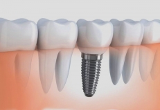 Имплантация – эффективный метод восстановления утраченных зубов