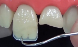 Що таке нарощування зубів?