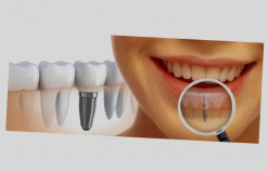 Як ставлять зубний Імплант?