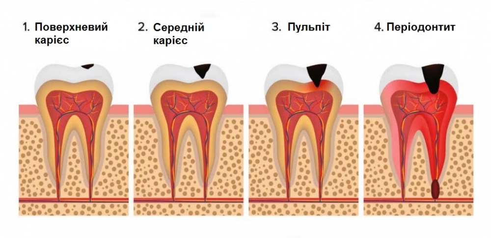 Пульпіт, періодонтит, карієс зубів 
