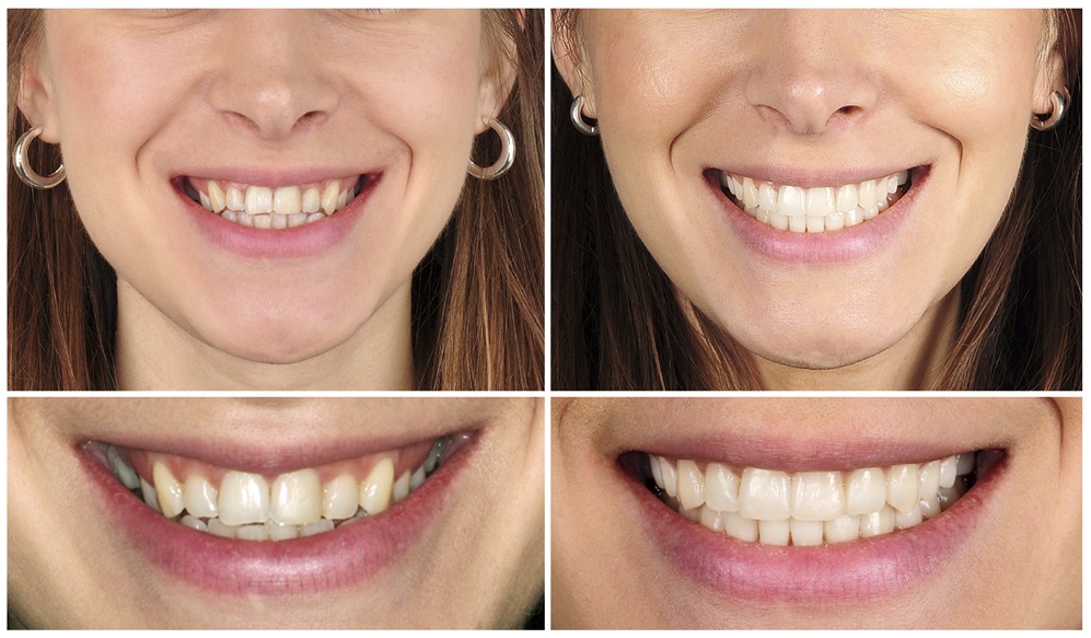 Переваги художньої реставрації зубів