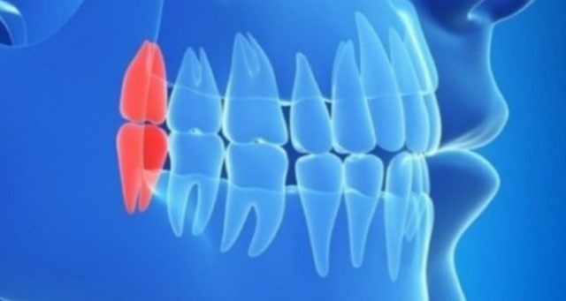 Миф 4: Зубы мудрости всегда нужно удалять перед ортодонтическим лечением