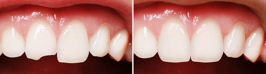 реставрация (наращивание) зубов в Виннице