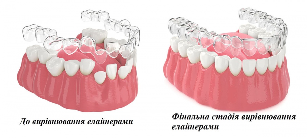 вирівнювання зубів 