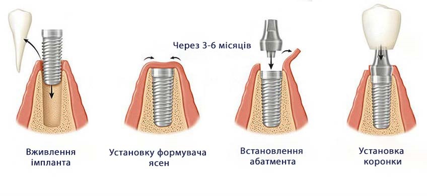 Протезування зубів