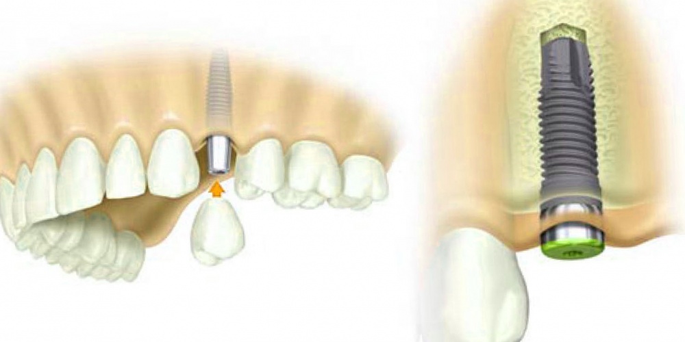 Переваги імплантації зубів
