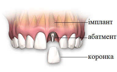 Процедура імплантації зубів