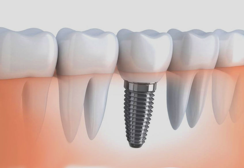 Имплантация зубов
