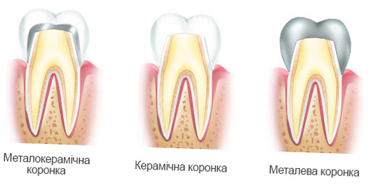 види коронок