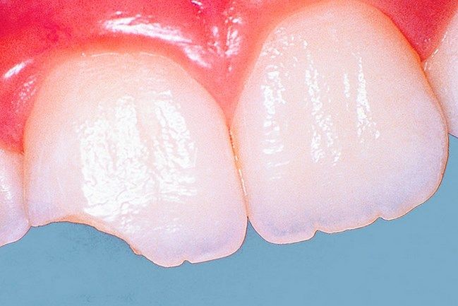 наслідки сколу поверхні зуба