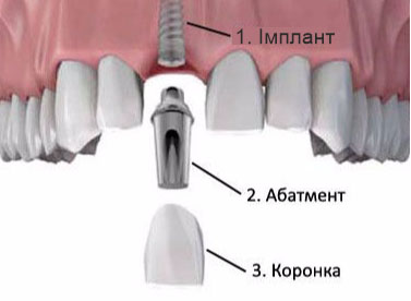 приживление зубного импланта