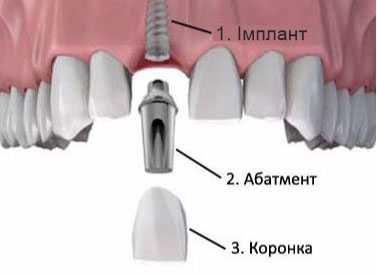 приживлення зубного імпланта