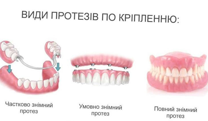 виды съемного протезирования