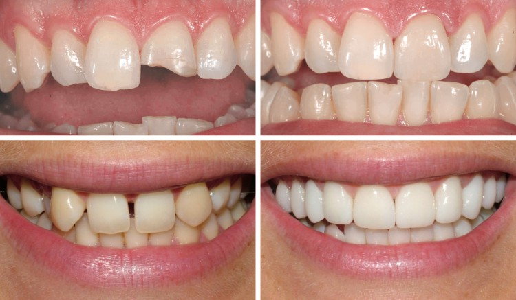 естетичні недоліки усуває художня реставрація зубів