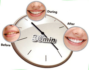 Переваги відбілювання зубів у клініці Пріор