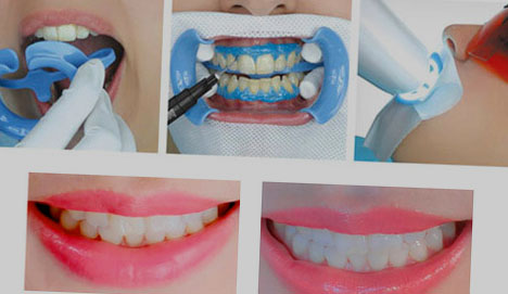 Процедура відбілювання зубів