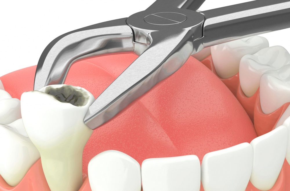 Видалення зубів у стоматологічній клініці Пріор