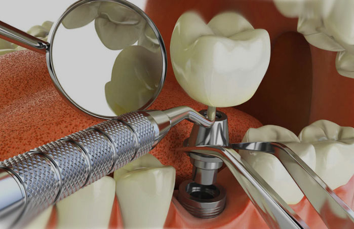 зубная имплантация